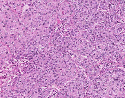Carcinoma de células escamosas (CCE)