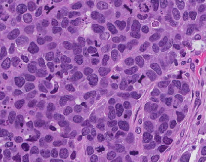 Carcinoma (indiferenciado) de células grandes