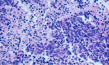 Cáncer de pulmón de células pequeñas (CPCP)